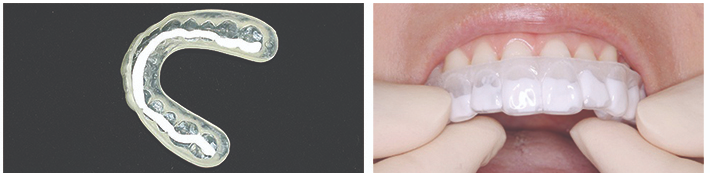 치아성분 치아영양제 아파프로로 약해진 치아관리! / 강남레옹치과 관련 이미지 9