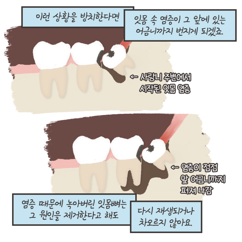 사랑니 안 뽑으면? 묻고 떠블로 가!! (냐폴레옹 치과툰) 관련 이미지 9