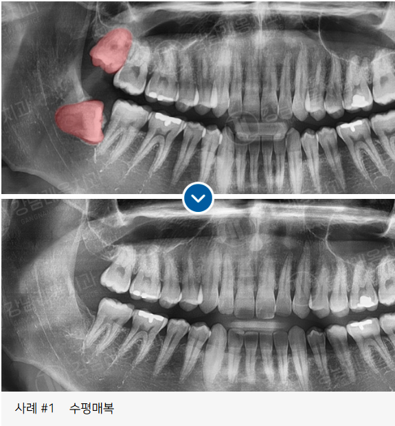 사랑니 발치, 왜 어떤 경우에 대학병원을 권유할까? / 강남레옹치과 관련 이미지 9