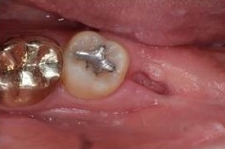 사랑니 발치 후 회복과정 한 눈에 보기🔍 / 강남역 사랑니 강남레옹치과 관련 이미지 11