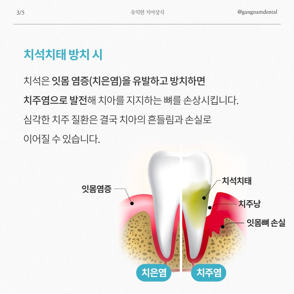 연 1회 스케일링 보험혜택 놓치지 마세요! / 주말 스케일링 / 강남레옹치과 관련 이미지 4