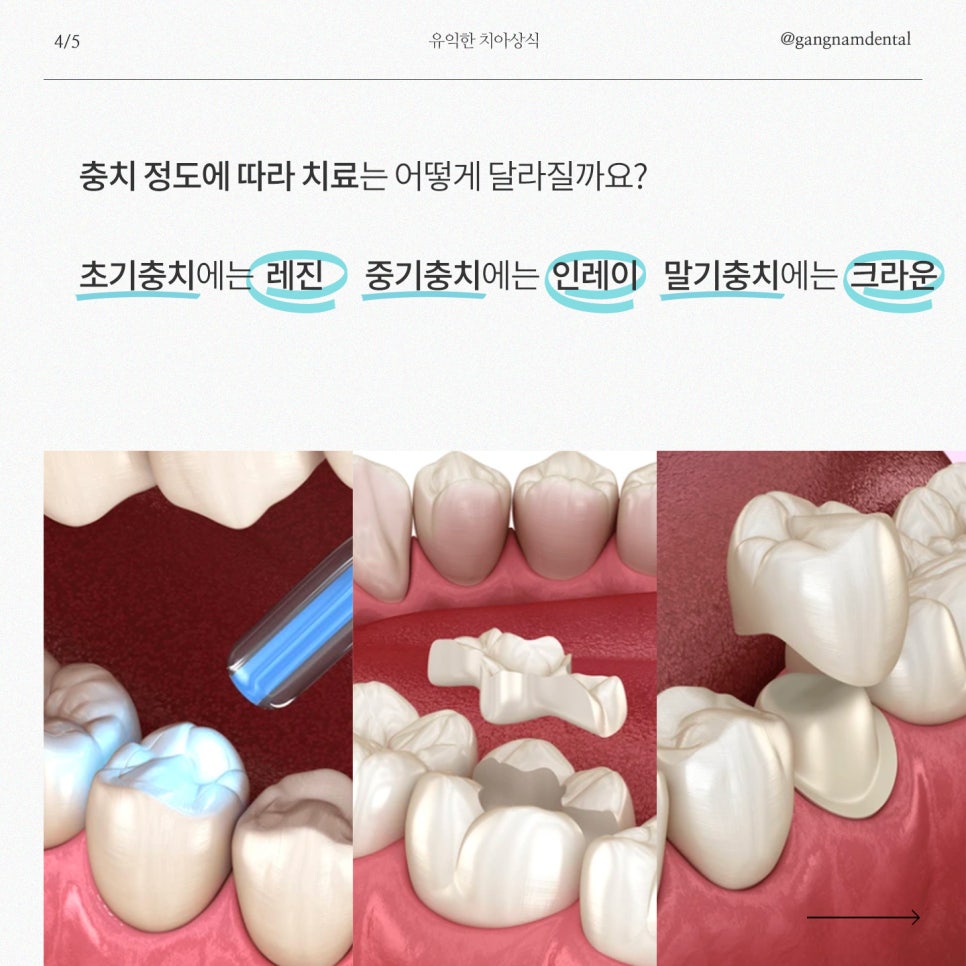 강남레옹치과에서 알려드리는 충치가 생기는 의외의 이유! 관련 이미지 5