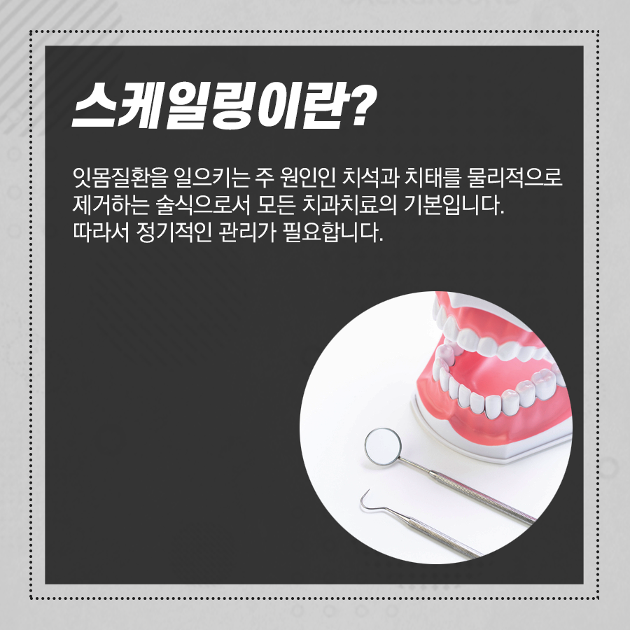 건강보험 적용 되는 치아 스케일링 효과 알고 받으면 더 좋아요! 관련 이미지 3
