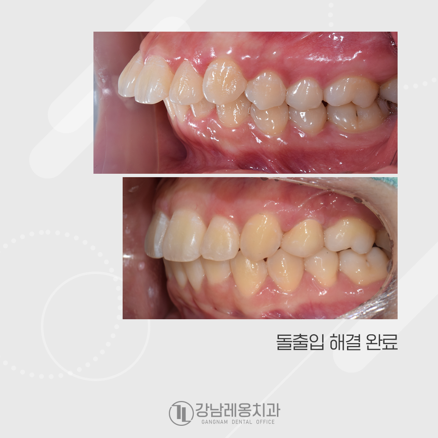 강남레옹치과 치아 교정, 돌출입 두가지 케이스 관련 이미지 4