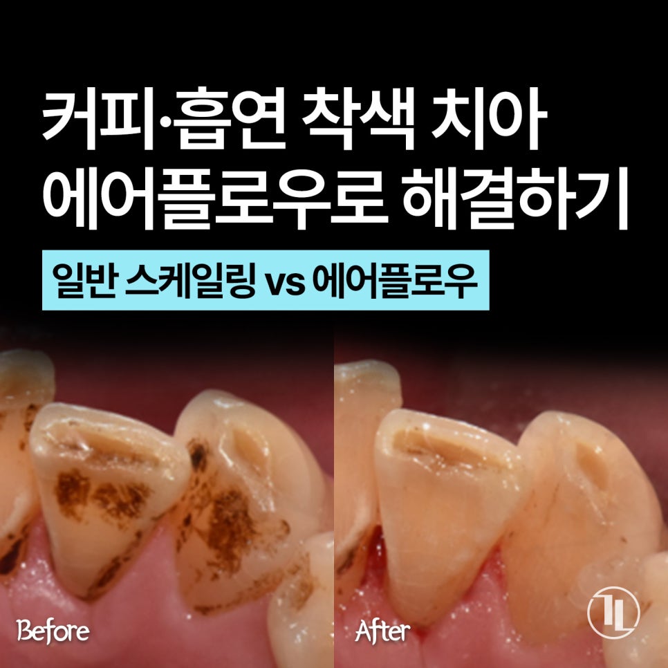 커피&middot;흡연 착색 치아 관리 첫 단계, 에어플로우 착색 제거 / 강남레옹치과 관련 이미지 1