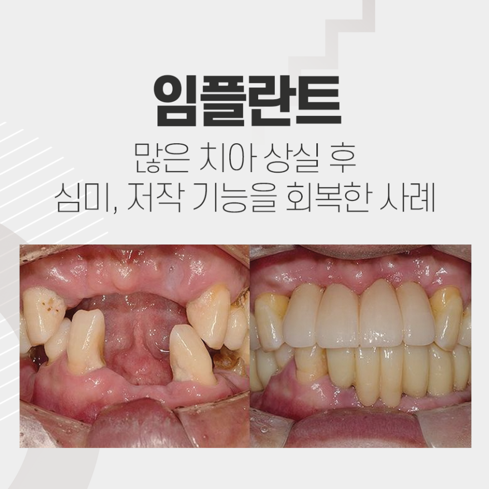 강남레옹치과 전악 임플란트 수술로 심미, 저작 기능을 회복해요. 관련 이미지 1