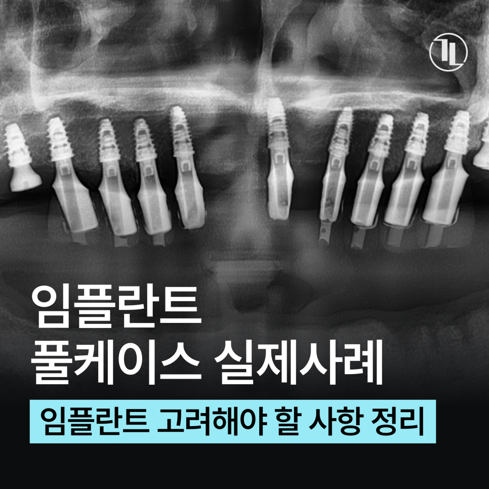 Full-Mouth Implant Treatment Case for Extensive Tooth Loss / Gangnam Leon Dental Clinic image 1