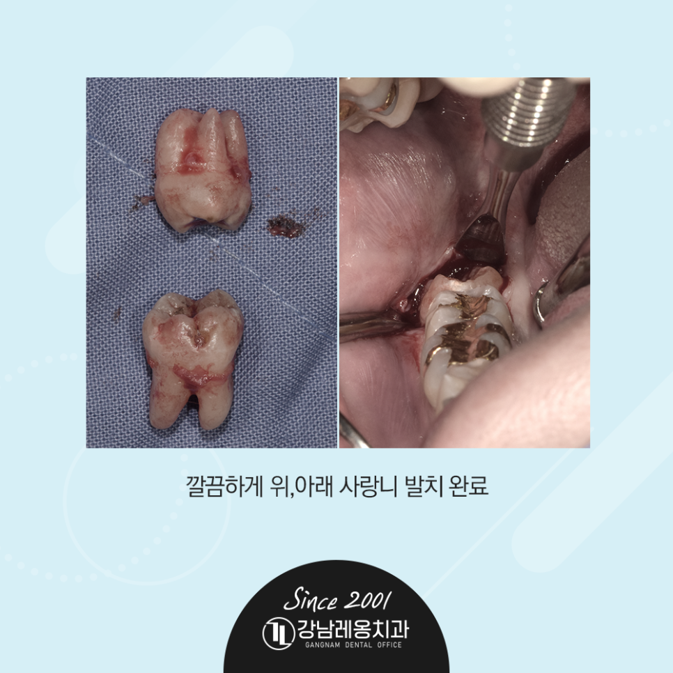 강남레옹치과 사랑니 발치! 통증 붓기 없이 2개를 한번에 뽑은 사례 관련 이미지 5