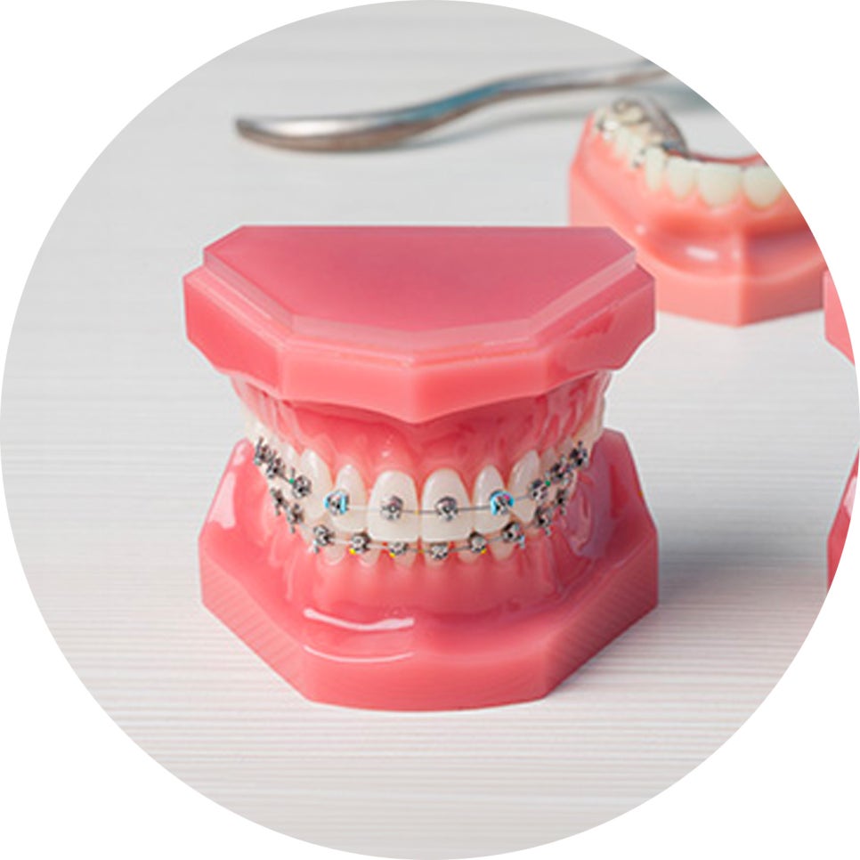 치아교정 종류와 선택법 & 관리 꿀팁 5가지!🖐️ / 강남레옹치과 관련 이미지 6