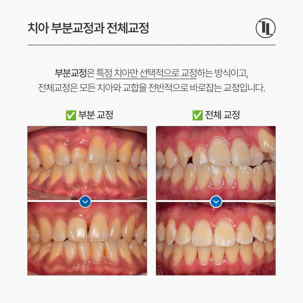 앞니 부분교정 가능여부와 기간 현실 정리! / 강남레옹치과 관련 이미지 2