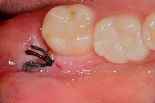 사랑니 발치 후 관리 & 회복 과정 한 눈에 보기👀! / 강남레옹치과 관련 이미지 5