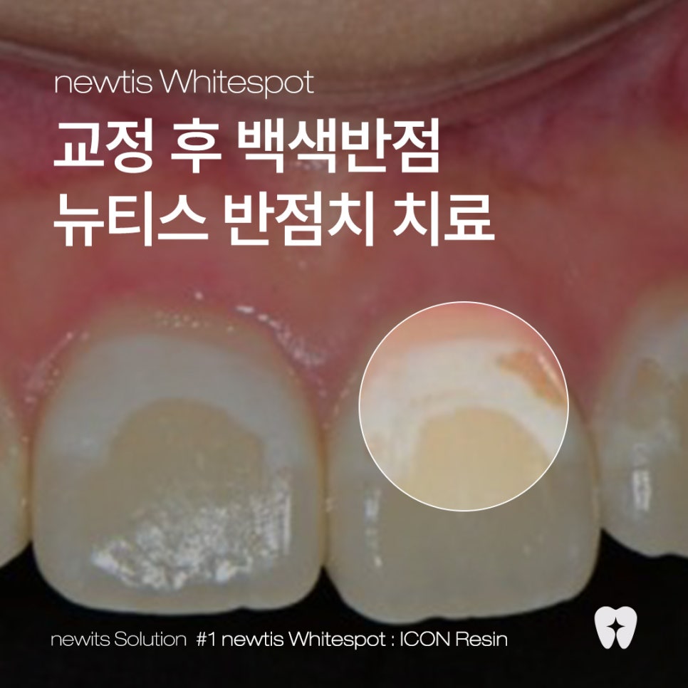 교정 후 치아에 백색반점이? 교정 후 치아탈회 삭제없이 뉴티스 반점치 치료 (아이콘레진) / 강남레옹치과 관련 이미지 1