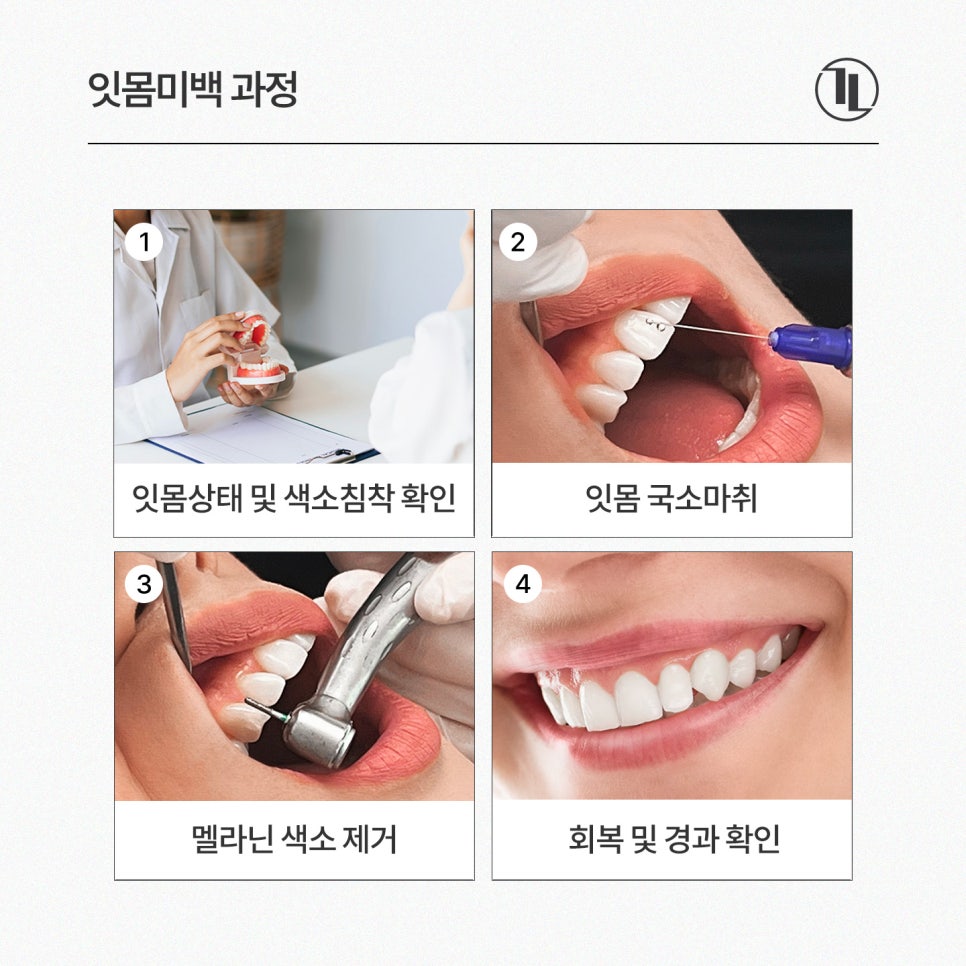 검은 잇몸, 원인부터 잇몸미백 치료과정, 주의사항까지 한눈에 보기👀 / 강남레옹치과 관련 이미지 3