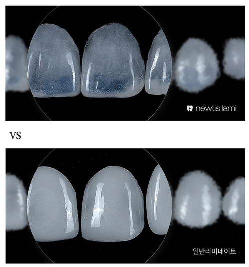 치아파절 개선방법, 뉴티스라미✨ / 강남레옹치과 관련 이미지 6