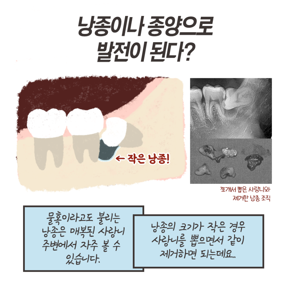 사랑니 발치 이유!! 최악의 경우 이렇게까지 된다..? (냐폴레옹툰 7화) 관련 이미지 10