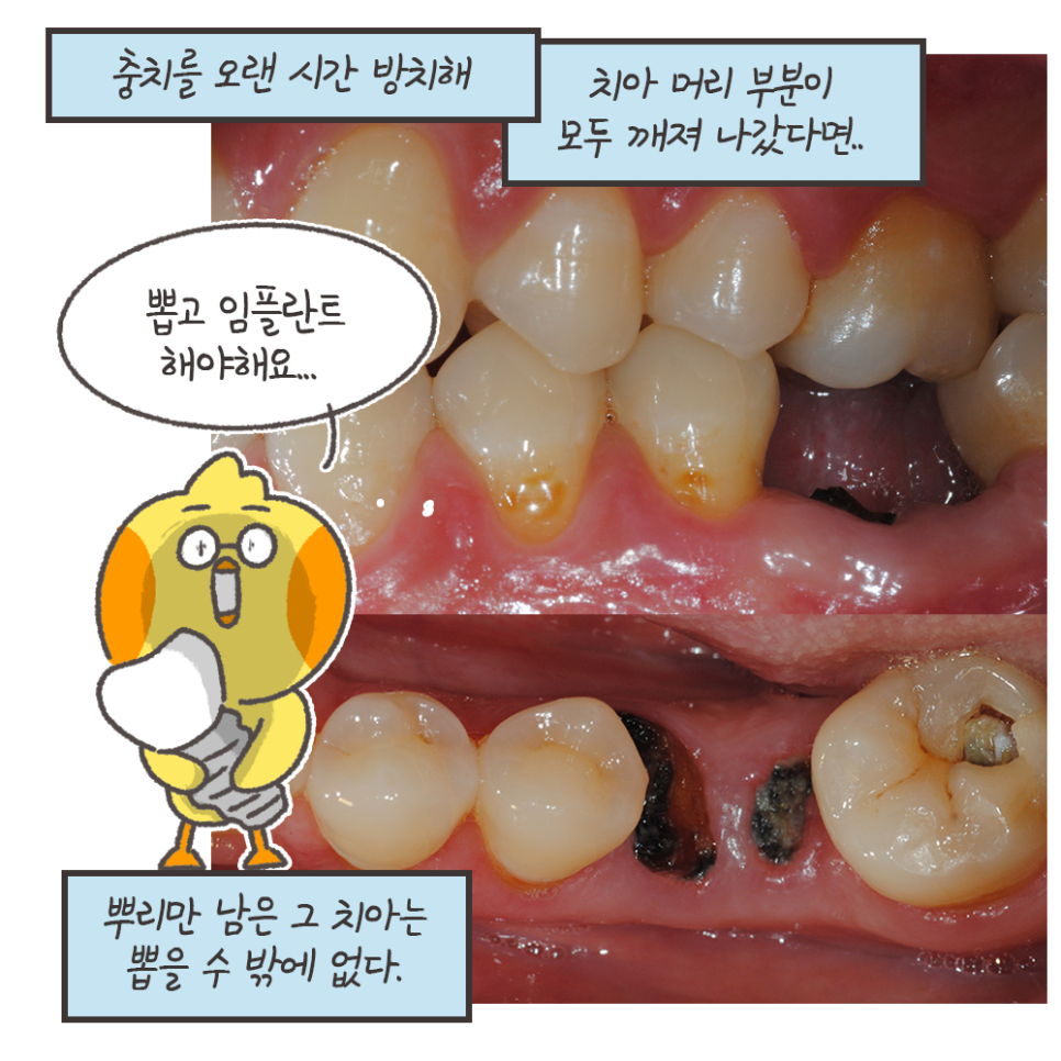 냐폴레옹 치과툰) 사람마다 다른 충치치료 비용 관련 이미지 11