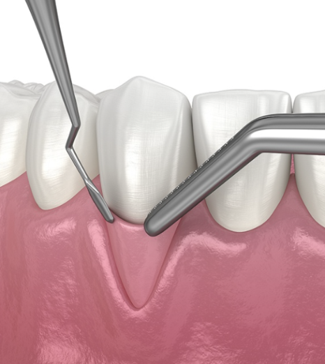 Gum Recession: Can It Expose the Tooth Roots? Before and After Gum Grafting! / Gangnam Leon Dental Clinic image 4