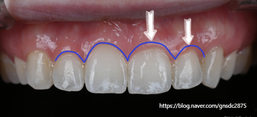 뉴티스 잇몸성형✨ 거미스마일 원인과 해결법, 잇몸성형으로 가능한가요? / 강남레옹치과 관련 이미지 3