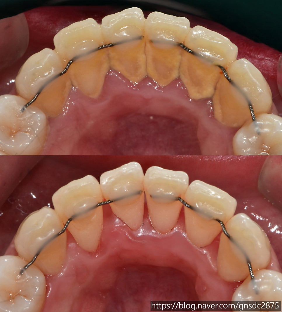 강남역 스케일링 맛집 / 치석 제거와 잇몸 건강의 핵심! / 핸드 스케일링 강남레옹치과 관련 이미지 17