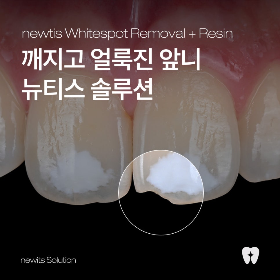 깨지고 하얗게 얼룩진 앞니, 라미네이트 대신 뉴티스 솔루션 / 강남레옹치과 관련 이미지 1