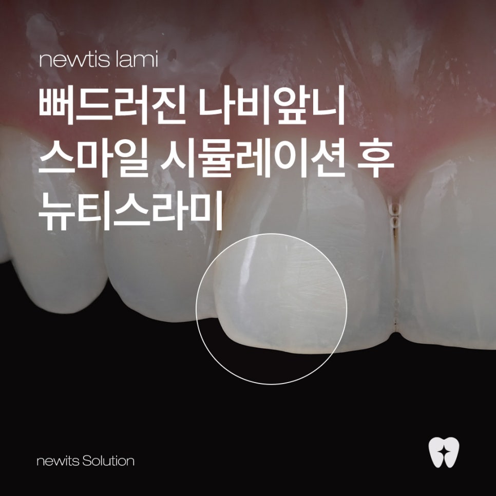 뻐드러진 나비앞니, 시술 전 스마일 시뮬레이션 후 뉴티스라미 관련 이미지 1