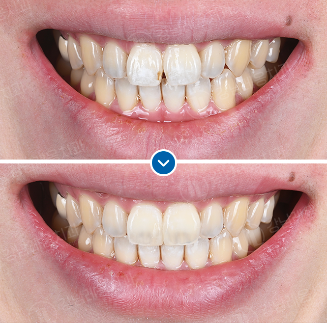 박영민 원장님의 뉴티스 앞니치료 세미나 in 몽골💫 관련 이미지 2