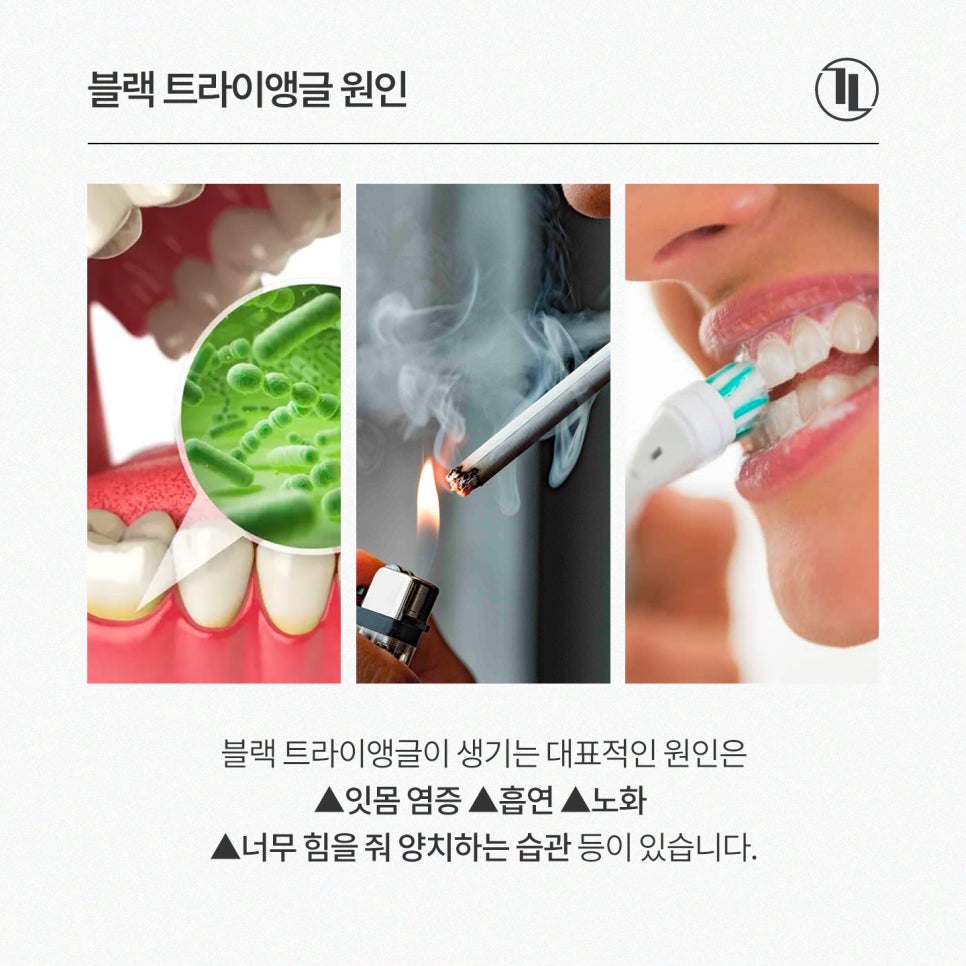 앞니 공간 블랙 트라이앵글 개선, 강남레옹치과 앞니치료 뉴티스 관련 이미지 3