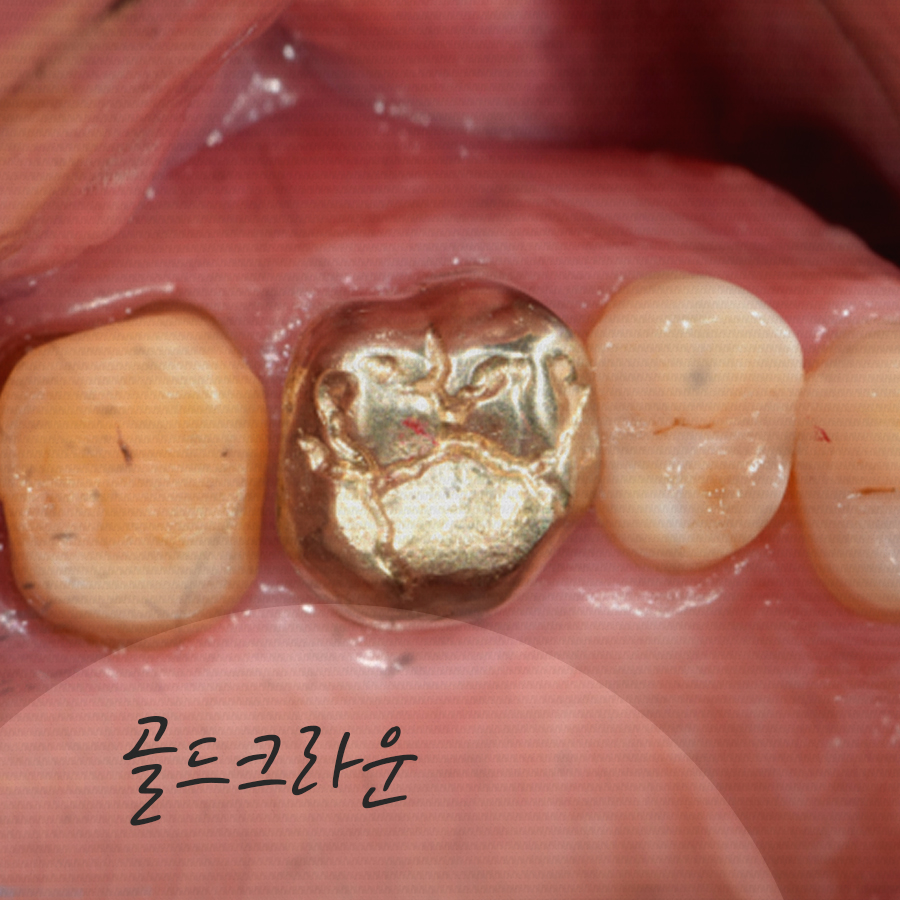 크라운치료 비용, 각자 특징과 장단점이 달라요. 관련 이미지 2