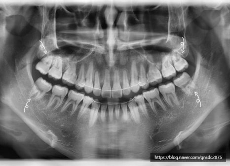 사랑니 통증, 약 먹으며 방치하면 안되는 이유! 실제 방치 사례🔍 / 강남레옹치과 관련 이미지 5