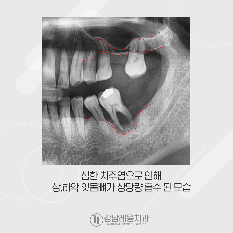 잇몸 염증 때문에 치조골 흡수, 발치 후 임플란트 수술 관련 이미지 2