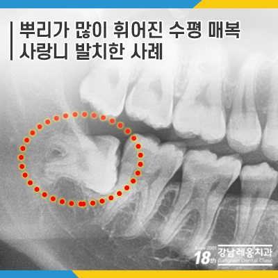 강남 레옹치과 뿌리 휘어진 사랑니 발치, 2개 한꺼번에 뽑은 사례 관련 이미지 7