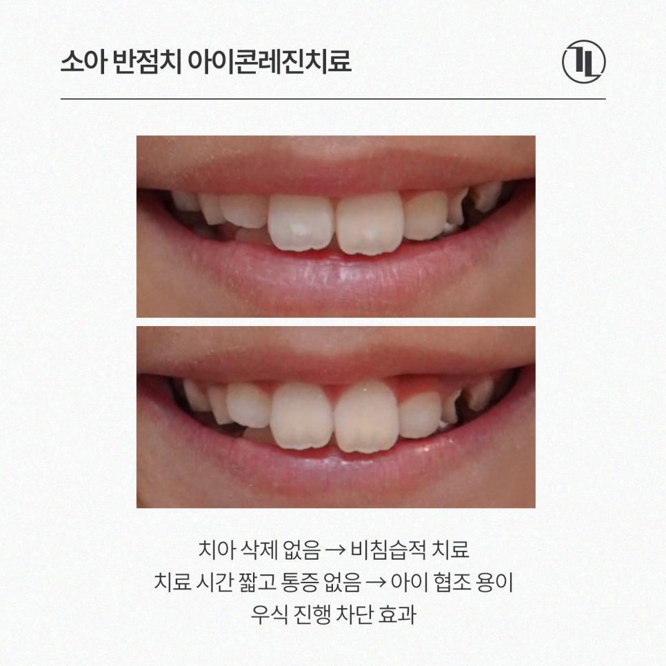 우리 아이 앞니에 하얀 반점! 소아 충치 시작의 신호? / 강남레옹치과 관련 이미지 7