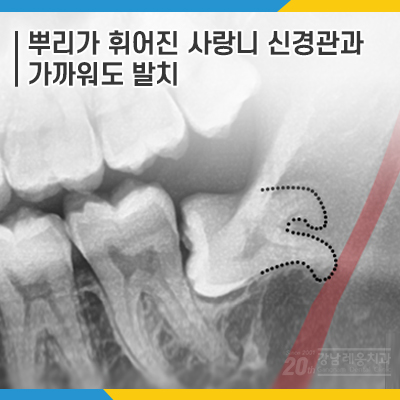 사랑니 발치 뿌리가 휘어졌는데도?? 관련 이미지 1