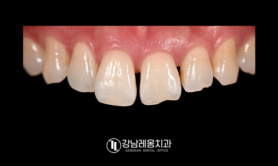 앞니 벌어짐 치료 후기 / 아이 앞니 벌어짐 건강하게 치료하려면? / 강남레옹치과 관련 이미지 5