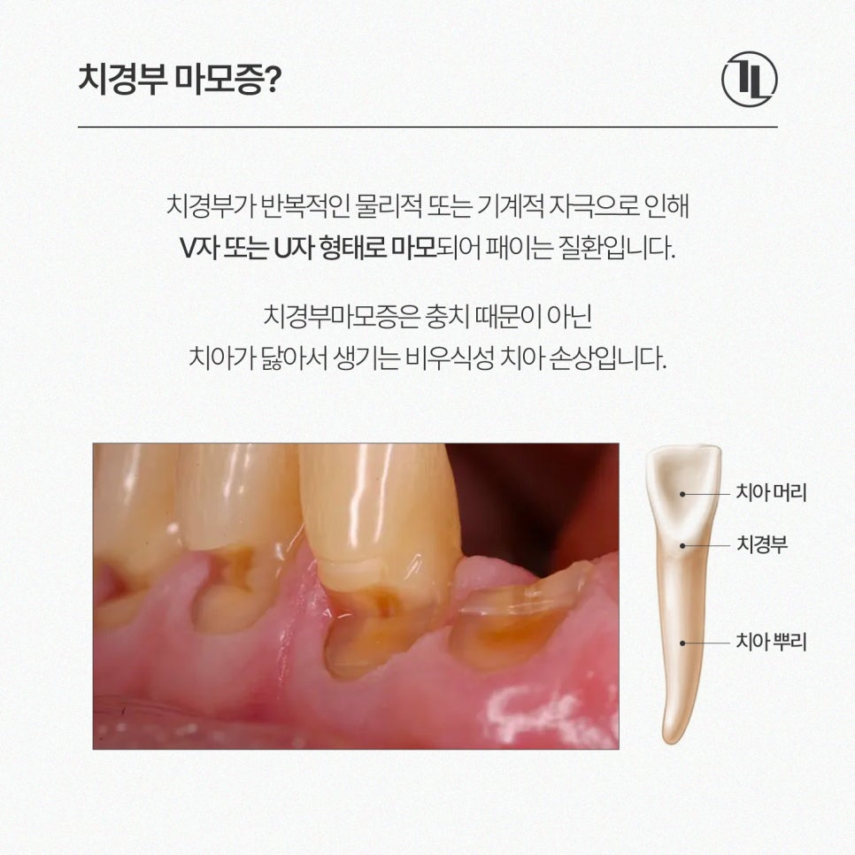 Tooth Notches and Tooth Sensitivity? Cervical Abrasion / Comparing Causes and Treatment Methods / Gangnam Leon Dental Clinic image 2