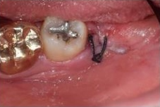 사랑니 발치 후 회복과정 한 눈에 보기🔍 / 강남역 사랑니 강남레옹치과 관련 이미지 4