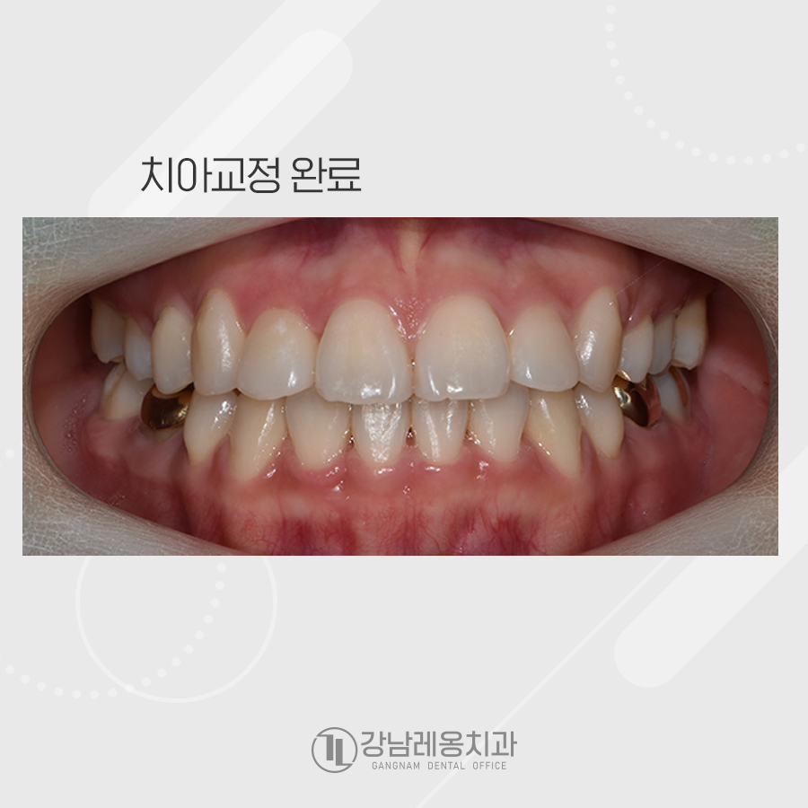 치아총생 덧니를 가지런하게 교정~! 관련 이미지 5
