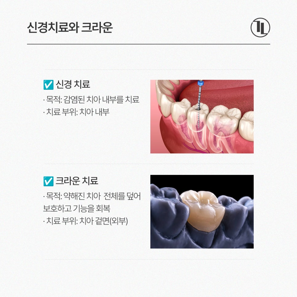 크라운 치료 가이드 / 충치&middot;신경치료 후 크라운과 가격&보험 / 강남레옹치과 관련 이미지 8