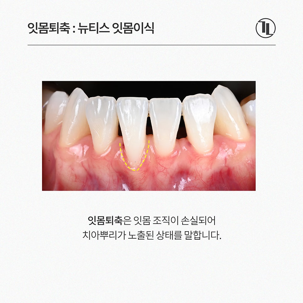 잇몸 내려앉음, 잇몸퇴축 잇몸이식으로 개선 / 강남레옹치과 관련 이미지 2
