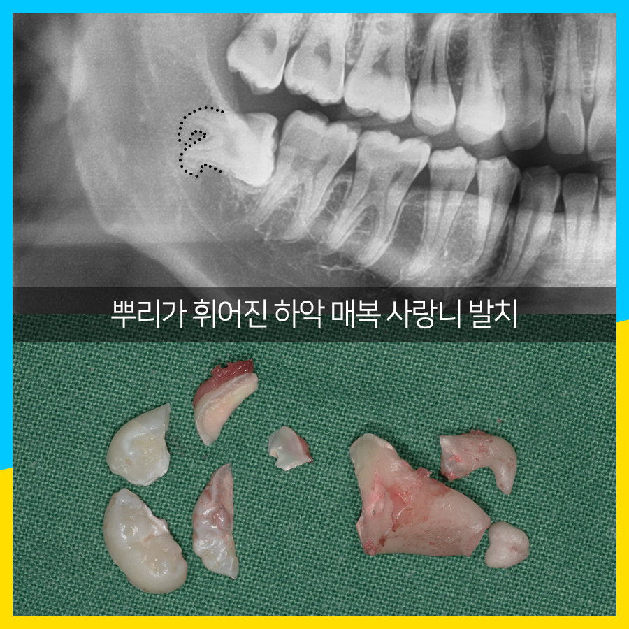 사랑니 발치 뿌리가 휘어졌는데도?? 관련 이미지 2