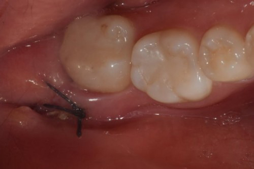 사랑니 발치 후 관리 & 회복 과정 한 눈에 보기👀! / 강남레옹치과 관련 이미지 3