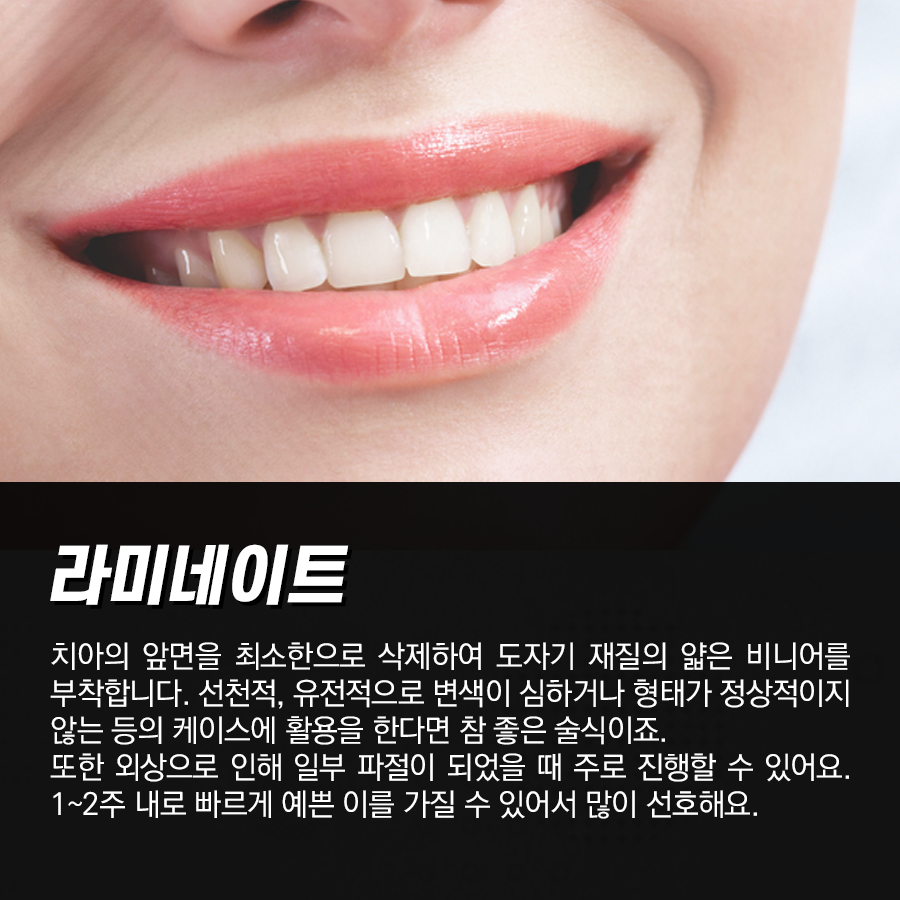 치아교정, 라미네이트 장단점과 차이점을 명확하게 알자! 관련 이미지 3