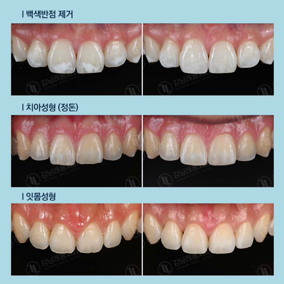 강남레옹치과 뉴티스, 라미네이트 말고도 예쁜 앞니 되찾는 법!? 관련 이미지 5
