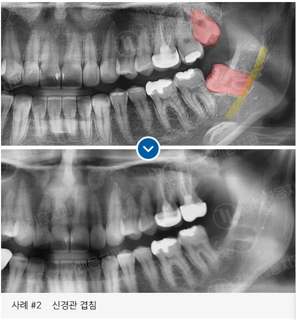 사랑니 발치, 왜 어떤 경우에 대학병원을 권유할까? / 강남레옹치과 관련 이미지 10
