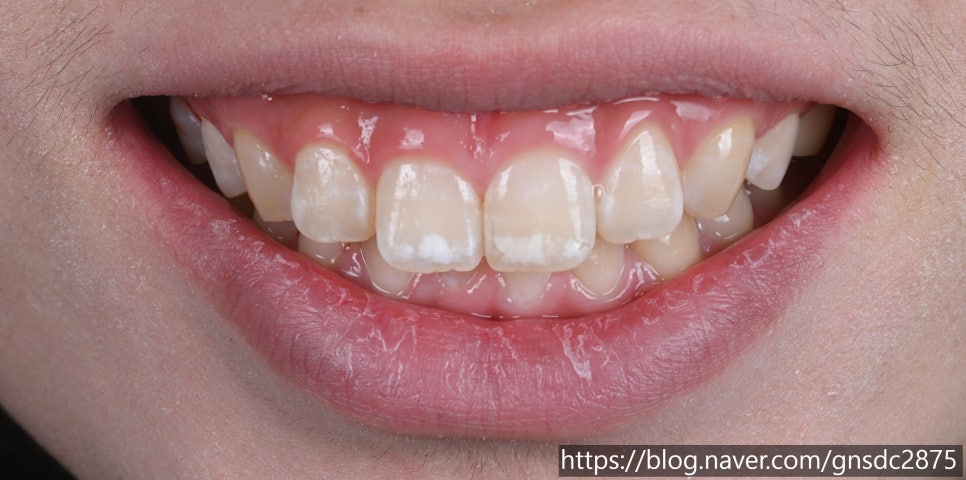 앞니 하얀얼룩 아이콘레진으로 말끔하게 / 뉴티스 반점치치료 / 강남레옹치과 관련 이미지 6