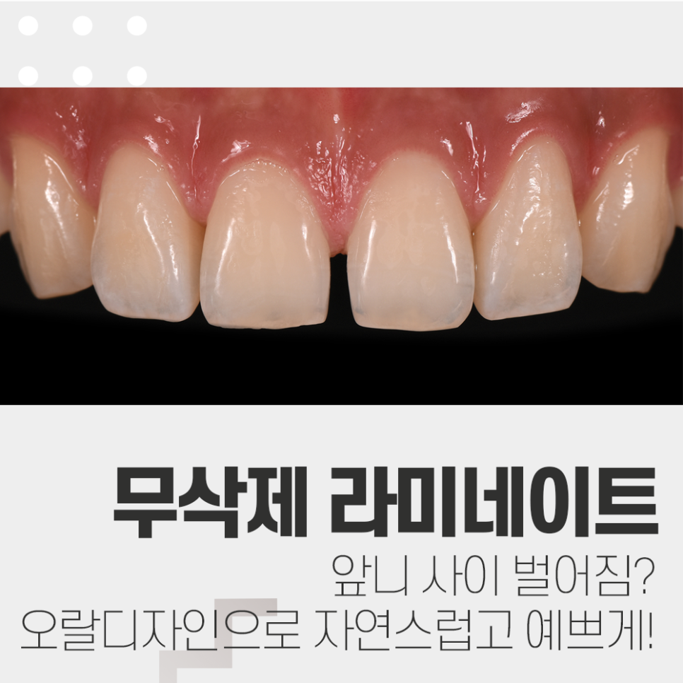 앞니 벌어짐 무삭제 라미네이트 치료는 장단점 꼭 확인! 관련 이미지 1