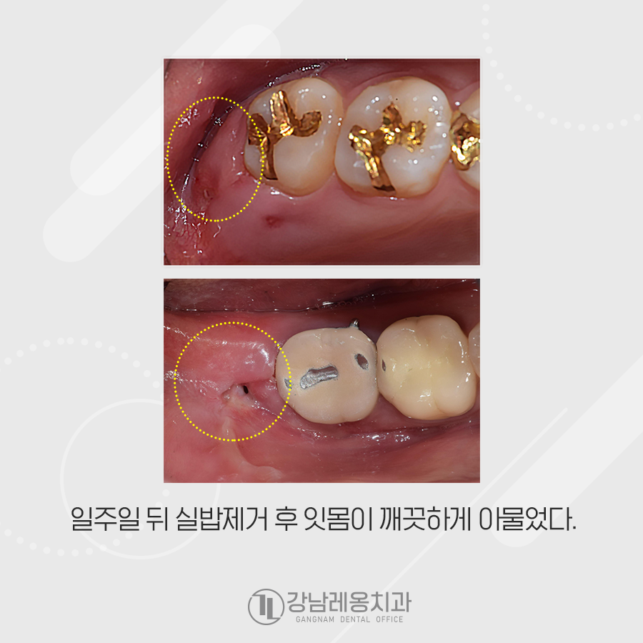 누운 사랑니 발치 통증 없이 깨끗하게 아물었던 강남레옹치과 증례 관련 이미지 5