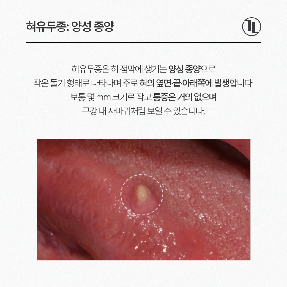 Small Bump (Growth) on the Tongue: Symptoms and Causes of Tongue Papilloma, and the Removal Process / Gangnam Leon Dental Clinic image 2