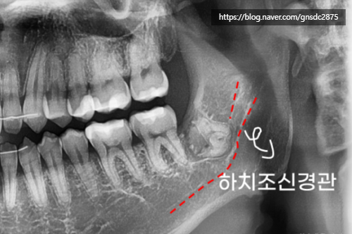뿌리를 남긴 사랑니 발치? / 강남역 사랑니발치 강남레옹치과 관련 이미지 2