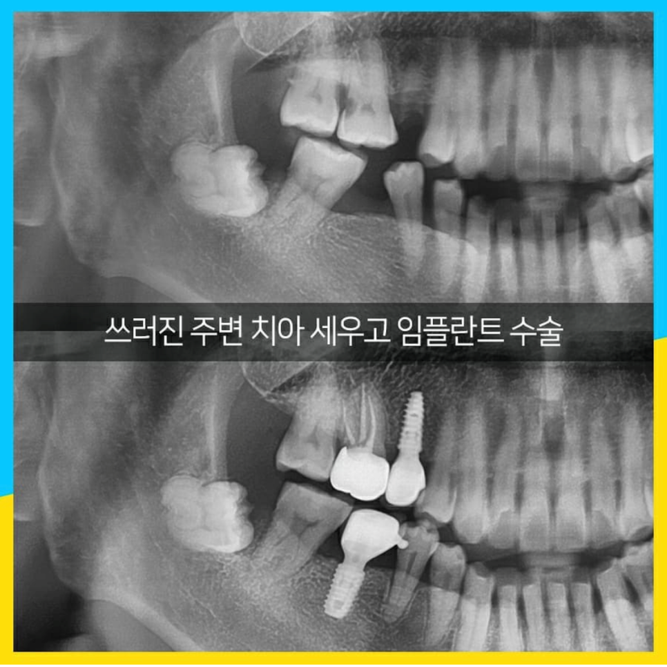 오래 방치했던 치아들 결국 임플란트 수술 관련 이미지 2